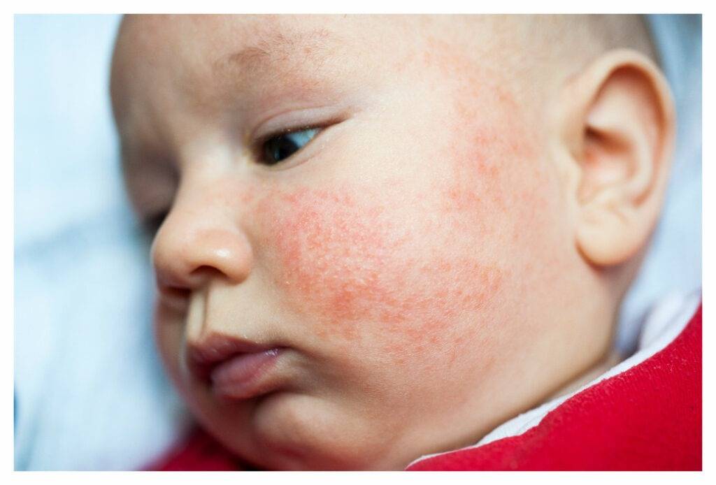 Asian baby with red baby eczema over his cheeks and forehead. The spots are not clearly defined and the skin between is inflamed