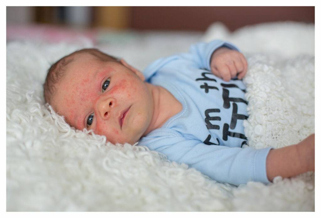 Baby boy with active, angry baby eczema on  his cheeks and forehead